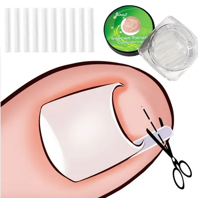 10pcs Ingrown Toenail Correction Tool Ingrown Toe Nail Treatment Elastic Patch Sticker Straightening Clip Brace 10pcs Ingrown Toenail Correction Tool Ingrown Toe Nail Treatment Elastic Patch Sticker Straightening Clip Brace