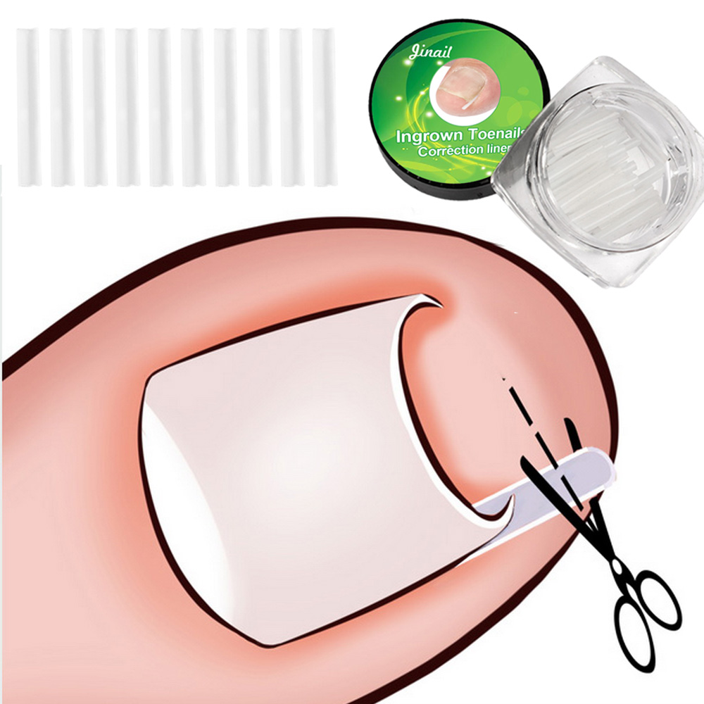 10pcs Ingrown Toenail Correction Tool Ingrown Toe Nail Treatment Elastic Patch Sticker Straightening Clip Brace 10pcs Ingrown Toenail Correction Tool Ingrown Toe Nail Treatment Elastic Patch Sticker Straightening Clip Brace