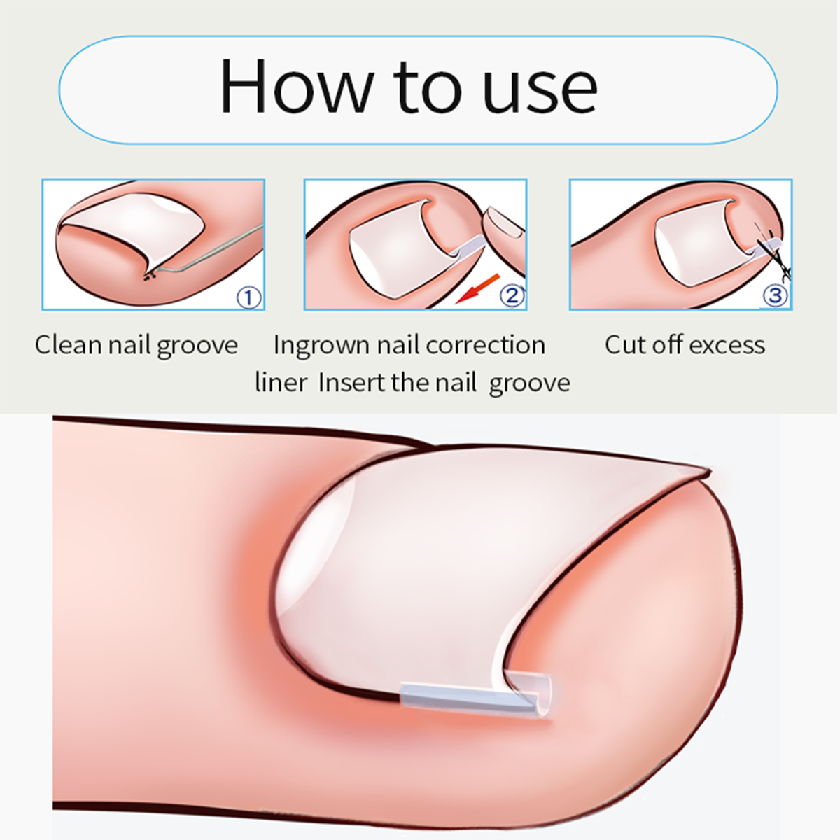 10pcs Ingrown Toenail Correction Tool Ingrown Toe Nail Treatment Elastic Patch Sticker Straightening Clip Brace 10pcs Ingrown Toenail Correction Tool Ingrown Toe Nail Treatment Elastic Patch Sticker Straightening Clip Brace