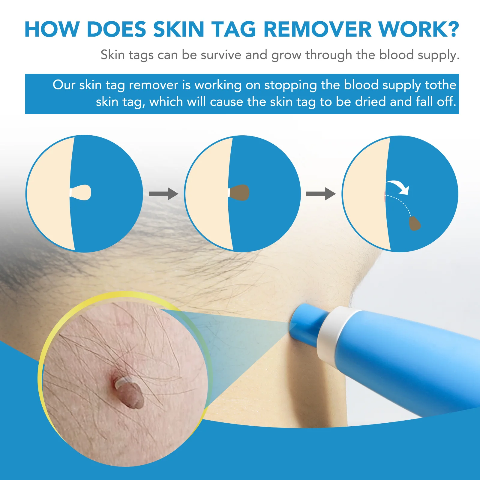 2 IN 1 Auto Skin Tag Remover Kit Micro Skin Tag Removal Device Adult Mole Stain Wart Remover Face Care Beauty Tools 2 IN 1 Auto Skin Tag Remover Kit Micro Skin Tag Removal Device Adult Mole Stain Wart Remover Face Care Beauty Tools