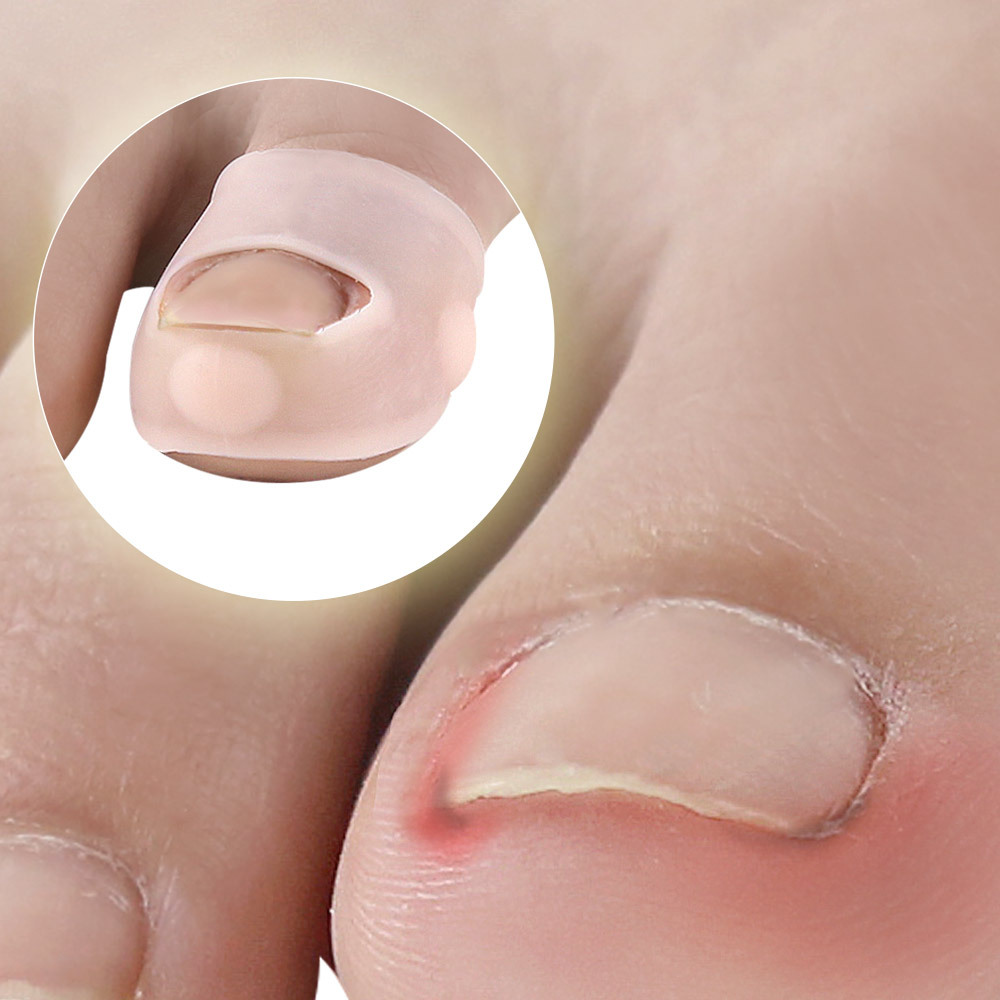 2pcs Silicone Ingrown Toenail Correction Tool Invisible Ingrown Toe Nail Treatment Elastic Straightening Clip Brace 2pcs Silicone Ingrown Toenail Correction Tool Invisible Ingrown Toe Nail Treatment Elastic Straightening Clip Brace