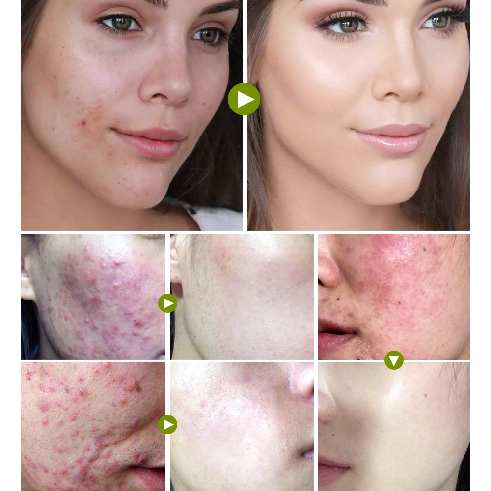 Acne Cream Facial Skin Care Acne Cream Facial Skin Care