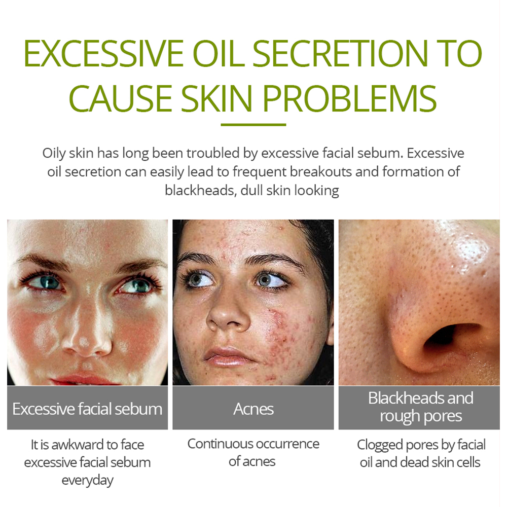 Acne Cream Facial Skin Care Acne Cream Facial Skin Care