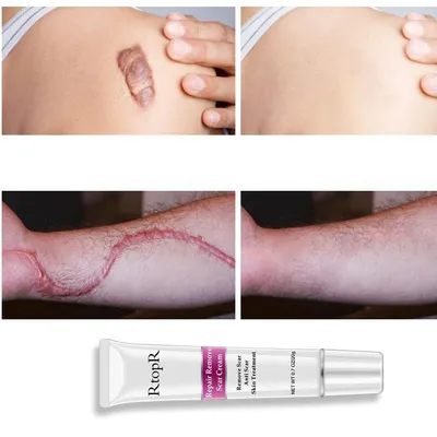 Acne Scar Cream Skin Repair