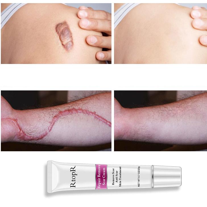 Acne Scar Cream Skin Repair