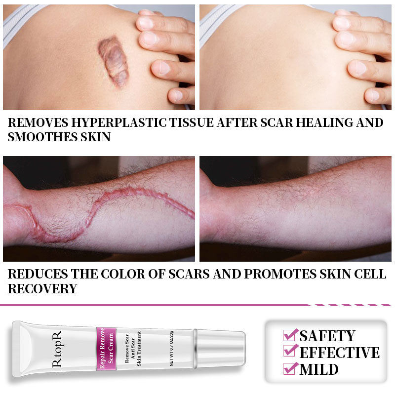 Acne Scar Cream Skin Repair