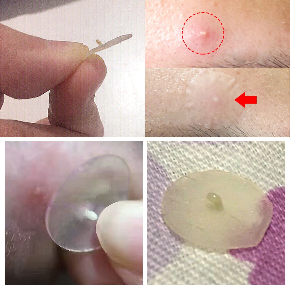 Acne Treatments Pimple Patch