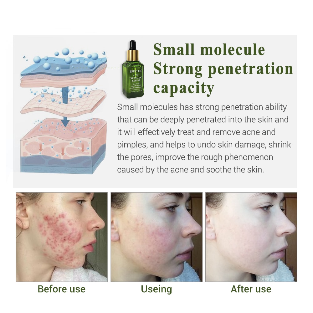 Acne Treatments Pimple Patch