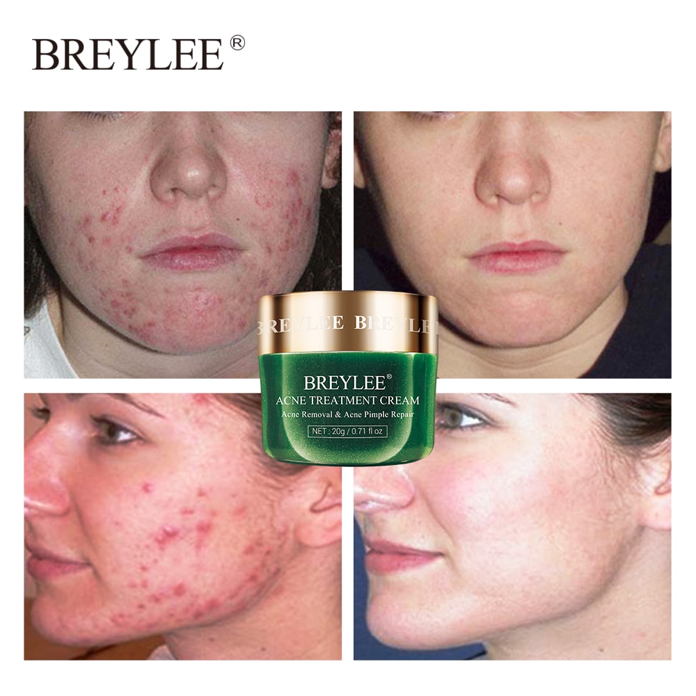 Acne Treatments Pimple Patch