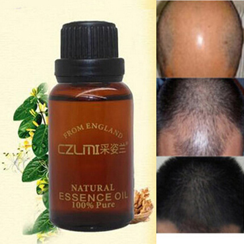 Alopecia Hair Loss Treatment Alopecia Hair Loss Treatment