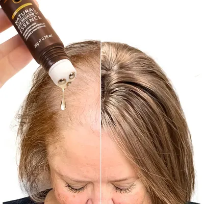 Anti Hair Loss Hair Growth Products Men Women Bald Remedy Roller Scalp Massage Treatment Ginger Fast Grow Hair Serum