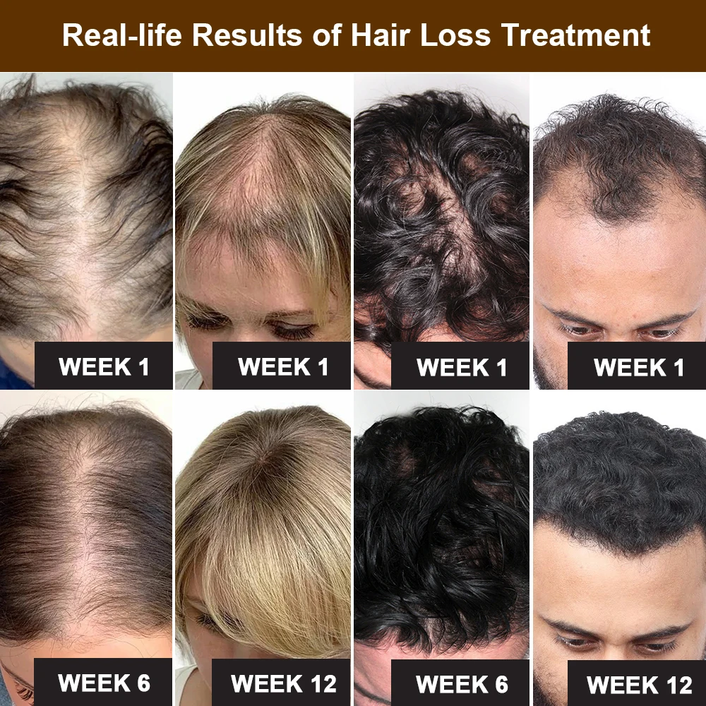 Anti Hair Loss Hair Growth Products Men Women Bald Remedy Roller Scalp Massage Treatment Ginger Fast Grow Hair Serum