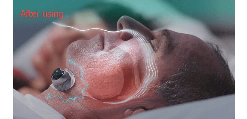 Anti-snoring Device Stopper Anti-snoring Device Stopper