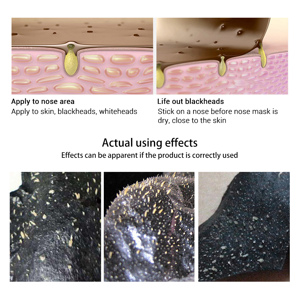 Blackhead Removal Mask Treatment Blackhead Removal Mask Treatment