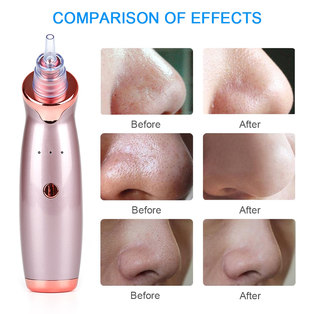 Blackhead Remover Vacuum Pore Cleanser Blackhead Remover Vacuum Pore Cleanser