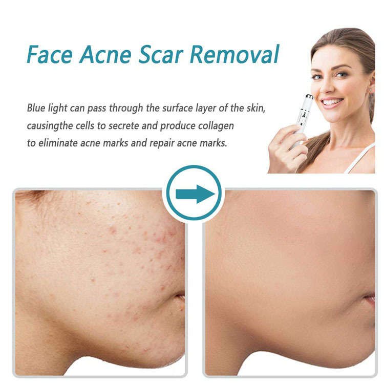 Blue Light Acne Wrinkle Removal Laser Pen Skin Spots Removal Anti Varicose Spider Vein Treatment Medical Blue Light Eye Blue Light Acne Wrinkle Removal Laser Pen Skin Spots Removal Anti Varicose Spider Vein Treatment Medical Blue Light Eye