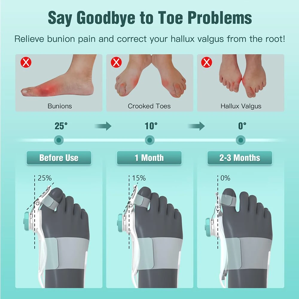 Bunion Corrector Adjustable Hallux Valgu Big Toe Valgus Corrector Rotatable Toe Corrector Straightener Adjustable Toe Bunion Corrector Adjustable Hallux Valgu Big Toe Valgus Corrector Rotatable Toe Corrector Straightener Adjustable Toe
