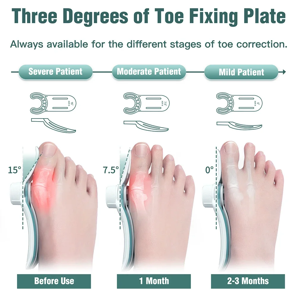 Bunion Corrector Hallux Valgus Orthotics Big Toe Homing Straightener Adjustable Knobs With 3 Angle Fixing Plate Foot Bunion Corrector Hallux Valgus Orthotics Big Toe Homing Straightener Adjustable Knobs With 3 Angle Fixing Plate Foot