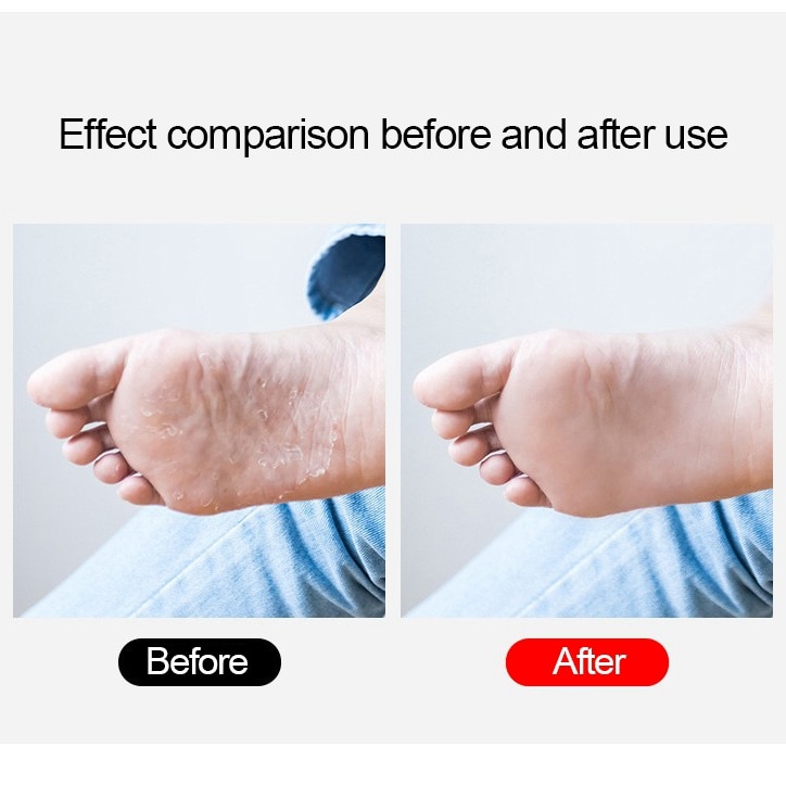 Callus File Dead Skin Remover