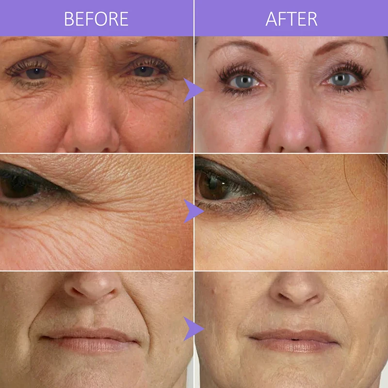 Collagen Face Serum Wrinkle Removal Anti Aging Skin Care Hyaluronic Acid Forehead Fine Lines Lifting Repair Facial Serum Collagen Face Serum Wrinkle Removal Anti Aging Skin Care Hyaluronic Acid Forehead Fine Lines Lifting Repair Facial Serum