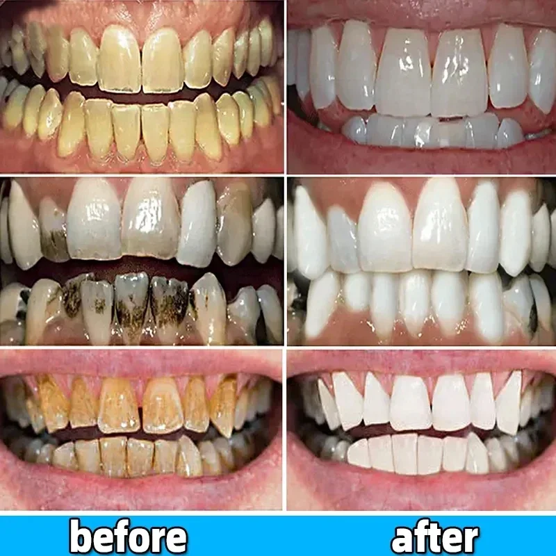 Dental Calculus Remover Whitening Removal Bad Breath Teeth Toothpaste Brightening Preventing Periodontitis Dental
