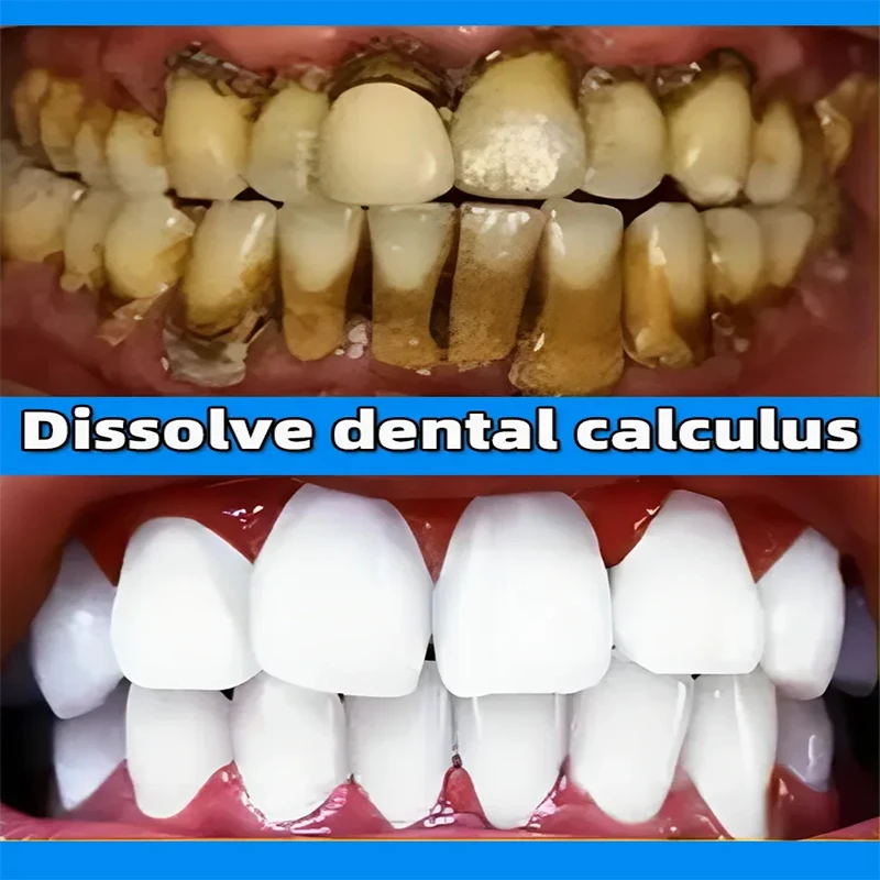 Dental Calculus Remover Whitening Removal Bad Breath Teeth Toothpaste Brightening Preventing Periodontitis Dental
