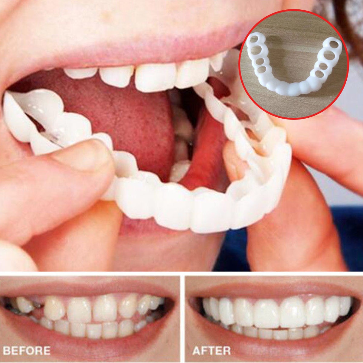 Dental Veneers Teeth Caps Dental Veneers Teeth Caps