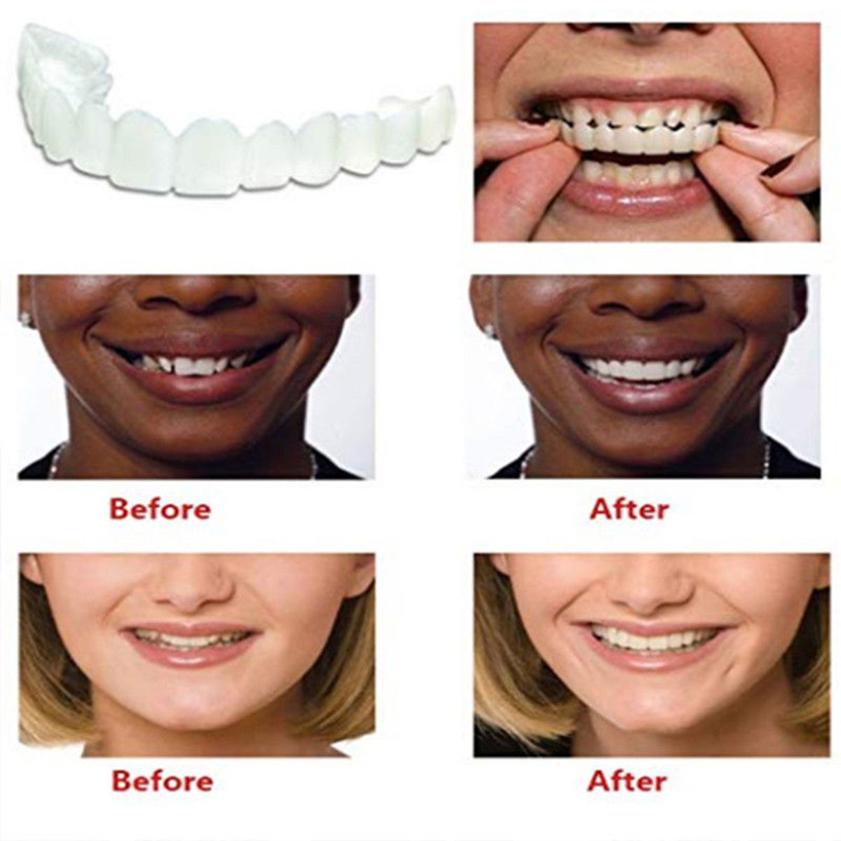 Dental Veneers Teeth Caps Dental Veneers Teeth Caps