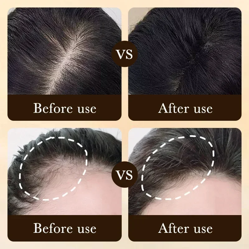 Fast Hair Growth Essence Effective Anti Hair Loss Serum Baldness Repair Hereditary Postpartum Seborrheic Hair Loss oil Fast Hair Growth Essence Effective Anti Hair Loss Serum Baldness Repair Hereditary Postpartum Seborrheic Hair Loss oil