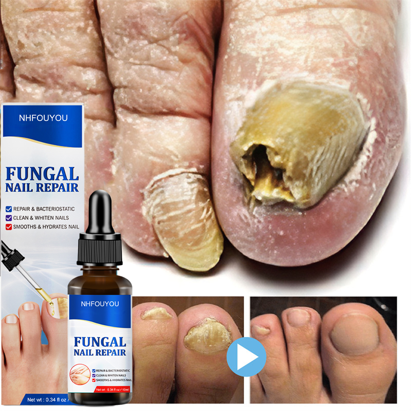 Fungal Nail Treatment Oil Foot Repair Essence Toe Nail Fungus Removal Gel Anti Infection Cream Fungal Nail Removal 10ML Fungal Nail Treatment Oil Foot Repair Essence Toe Nail Fungus Removal Gel Anti Infection Cream Fungal Nail Removal 10ML