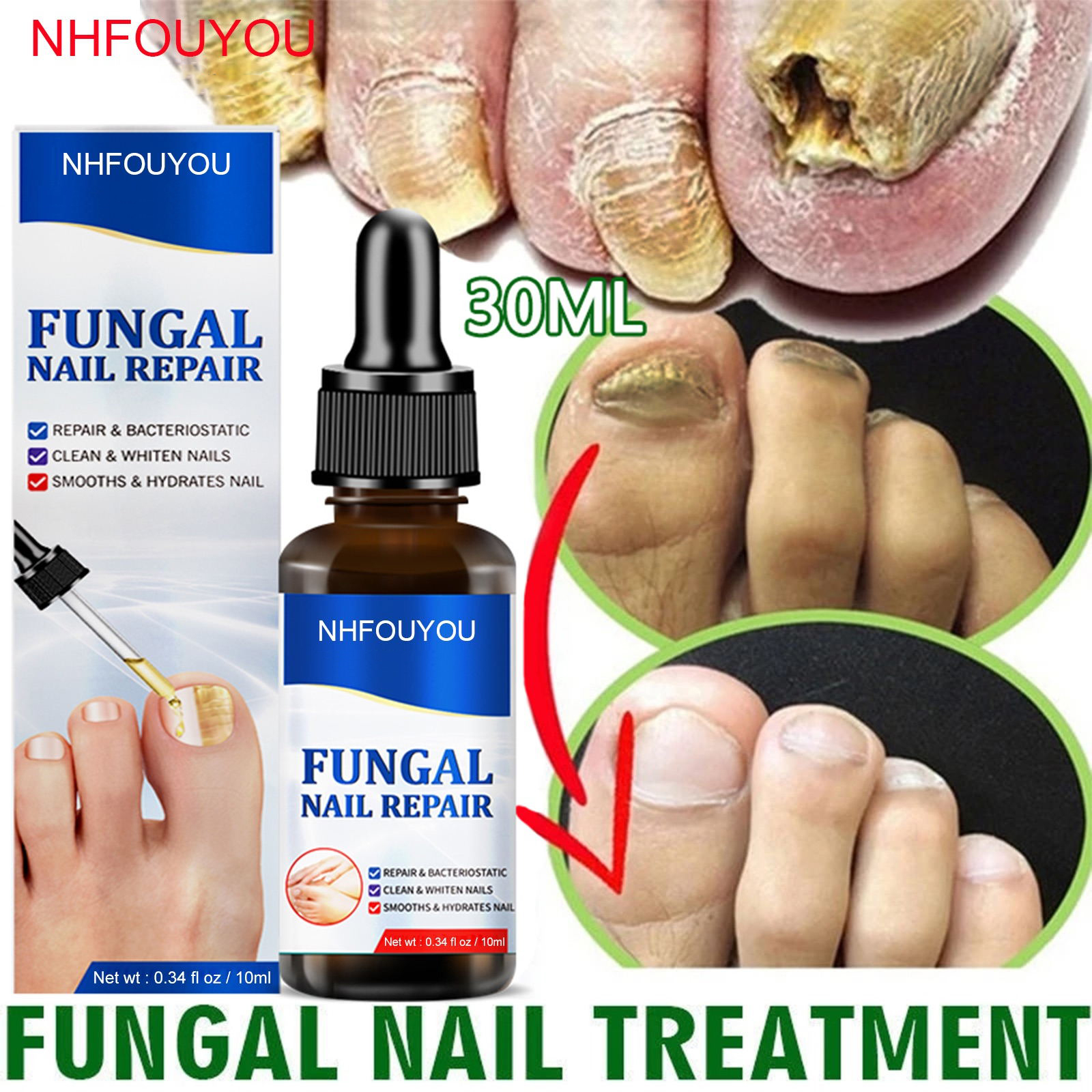 Fungal Nail Treatment Oil Foot Repair Essence Toe Nail Fungus Removal Gel Anti Infection Cream Fungal Nail Removal 10ML Fungal Nail Treatment Oil Foot Repair Essence Toe Nail Fungus Removal Gel Anti Infection Cream Fungal Nail Removal 10ML