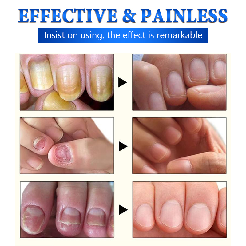 Fungal Nail Treatment Oil Foot Repair Essence Toe Nail Fungus Removal Gel Anti Infection Cream Fungal Nail Removal 10ML Fungal Nail Treatment Oil Foot Repair Essence Toe Nail Fungus Removal Gel Anti Infection Cream Fungal Nail Removal 10ML