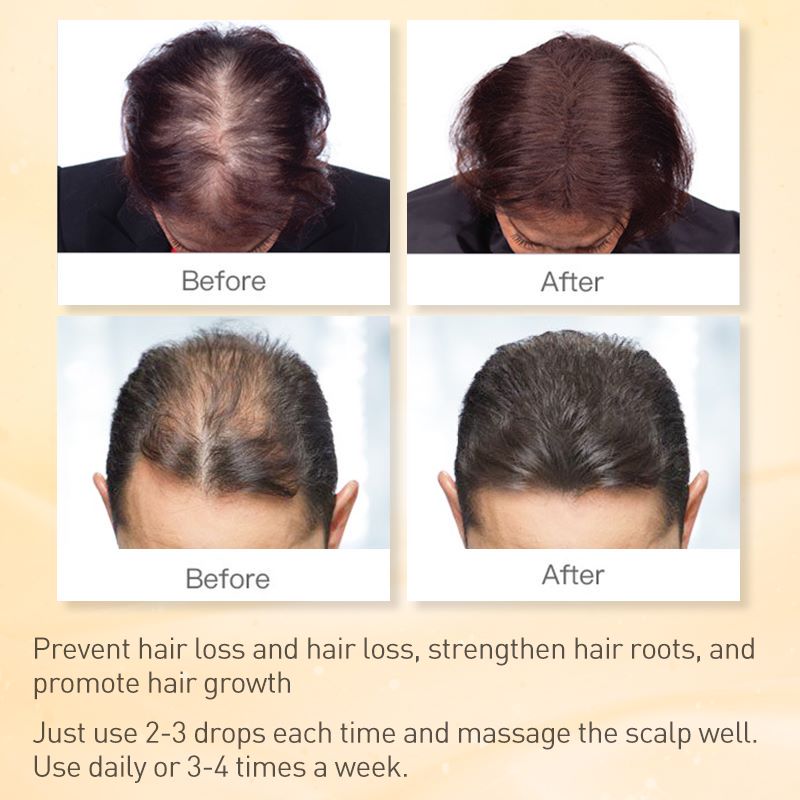 Ginger Hair Growth Products Prevent Hair Loss Essential Oil Fast Growing Scalp Treatment Beauty Health for Men Women Ginger Hair Growth Products Prevent Hair Loss Essential Oil Fast Growing Scalp Treatment Beauty Health for Men Women