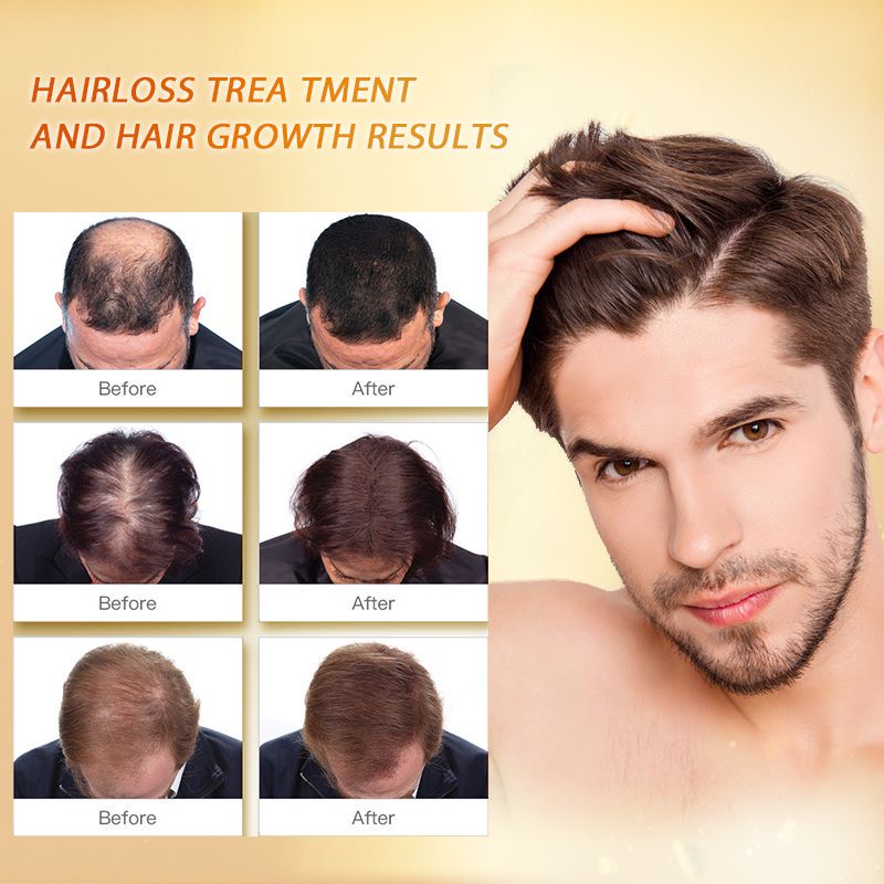 Ginger Hair Growth Products Prevent Hair Loss Essential Oil Fast Growing Scalp Treatment Beauty Health for Men Women Ginger Hair Growth Products Prevent Hair Loss Essential Oil Fast Growing Scalp Treatment Beauty Health for Men Women