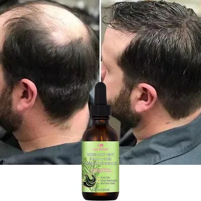 Hair Growth Oil Dense Hair Essential Oil Anti Hair Loss Nourishing Rosemary Smooth Nourishment Essential