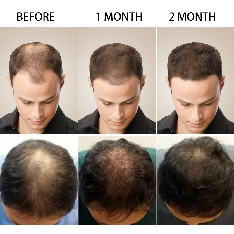 Hair Growth Oil Fast Hair Growth Products Scalp Treatments Prevent Hair Loss Thinning Beauty Hair Care for Men Women