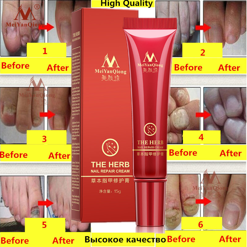 Herbal Antifungal Nail Treatment Cream Herbal Antifungal Nail Treatment Cream
