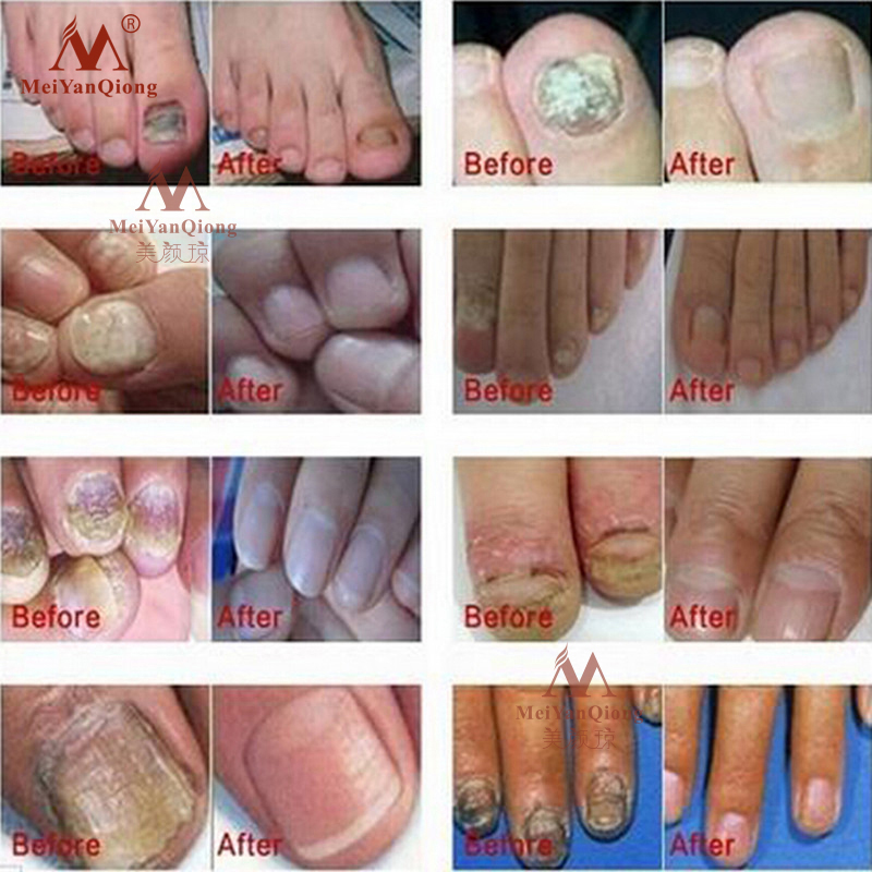Herbal Antifungal Nail Treatment Cream Herbal Antifungal Nail Treatment Cream