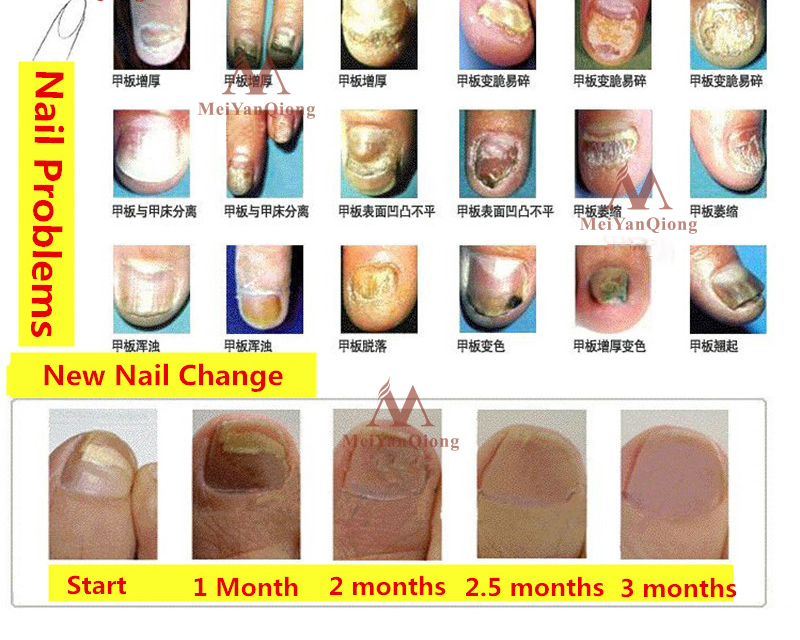 Herbal Antifungal Nail Treatment Cream Herbal Antifungal Nail Treatment Cream