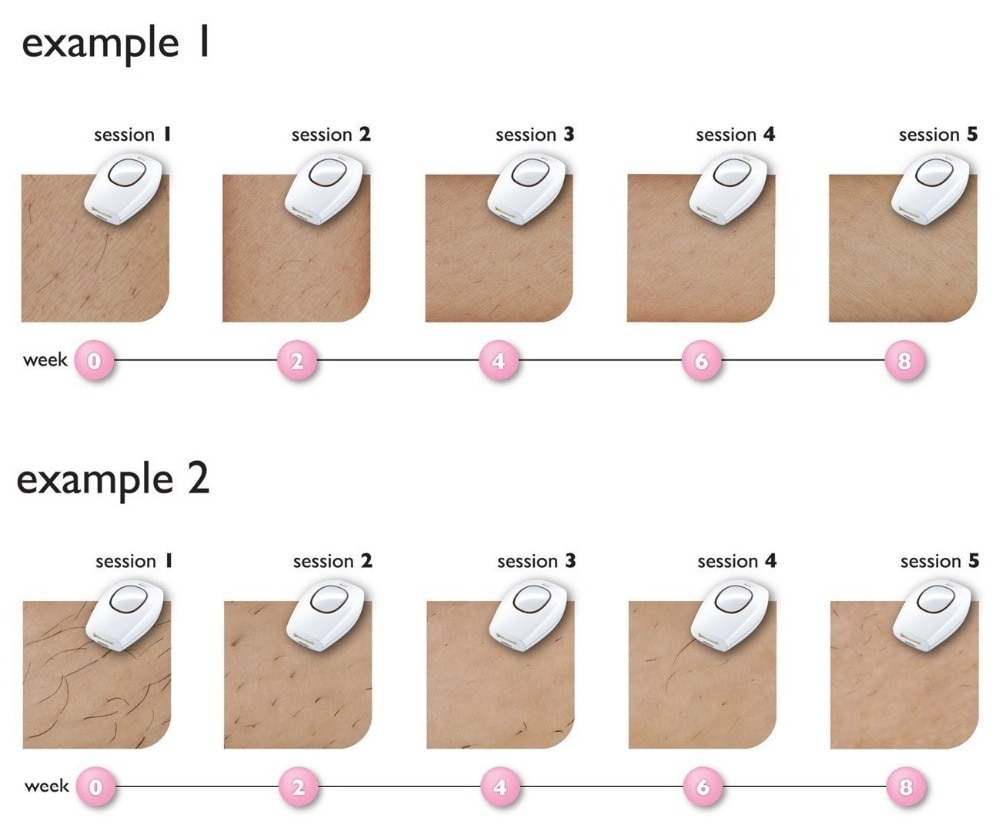 Intense Pulsed Light Permanent Epilator
