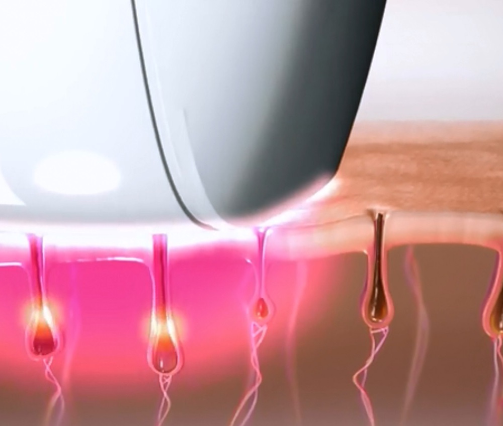 Laser Epilation Permanent Hair Removal Treatment Machine Laser Epilation Permanent Hair Removal Treatment Machine