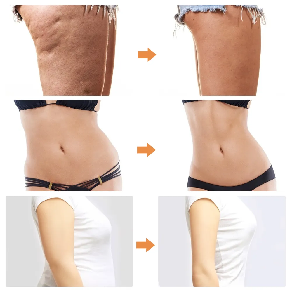 Liposuction Machine EMS VE Sport Belly Arm Leg Fat Burner Body Shaping Slimming Anti Cellulite Massager Fitness Weight Liposuction Machine EMS VE Sport Belly Arm Leg Fat Burner Body Shaping Slimming Anti Cellulite Massager Fitness Weight