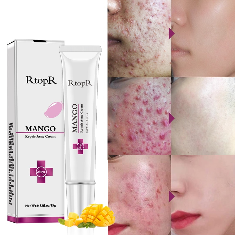 Mango Whitening Cream Acne Treatment