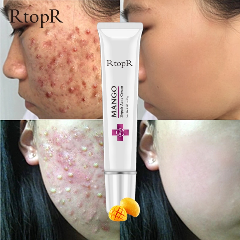 Mango Whitening Cream Acne Treatment