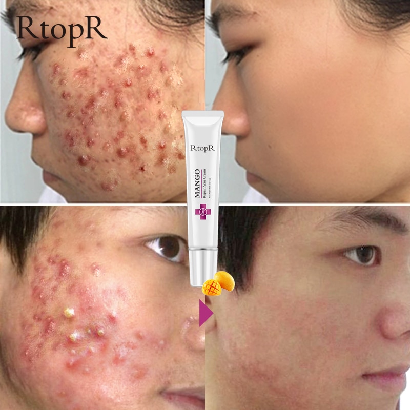Mango Whitening Cream Acne Treatment