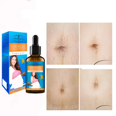 Maternity Stretch Mark Removal Essential Oil Maternity Stretch Mark Removal Essential Oil