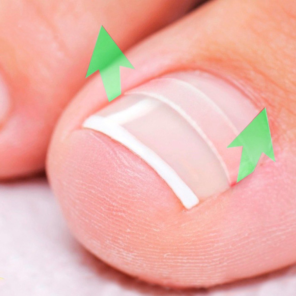Nail Care Ingrown Toenail Correction Tool Nail Care Ingrown Toenail Correction Tool