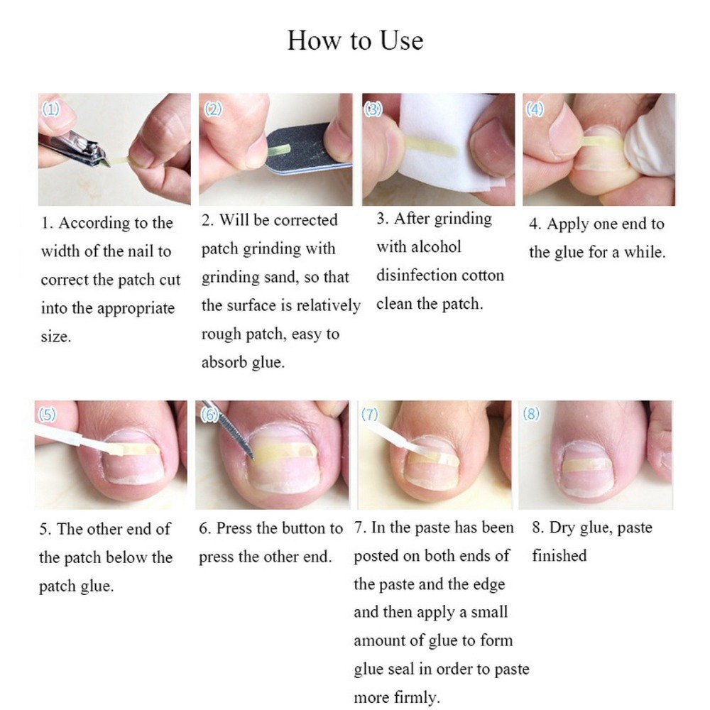 Nail Care Ingrown Toenail Correction Tool Nail Care Ingrown Toenail Correction Tool