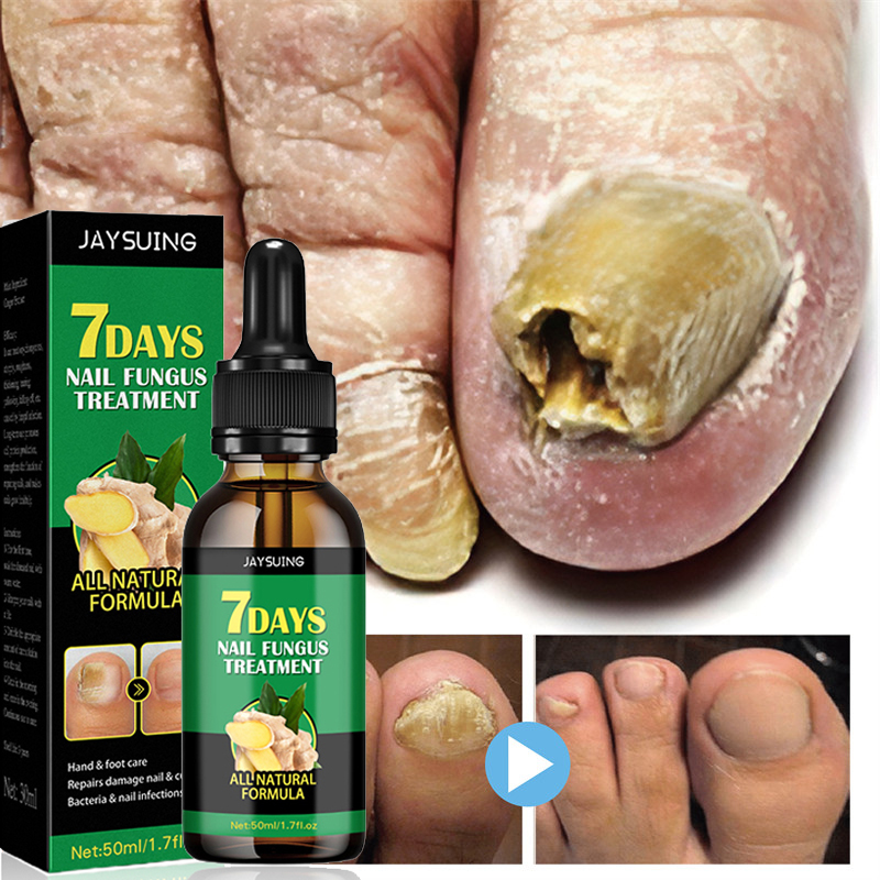 Nail Fungal Treatment Essence Oil Foot Toe Nail Fungus Removal Serum 7 Days Repair Onychomycosi Anti Infection Gel Care Nail Fungal Treatment Essence Oil Foot Toe Nail Fungus Removal Serum 7 Days Repair Onychomycosi Anti Infection Gel Care