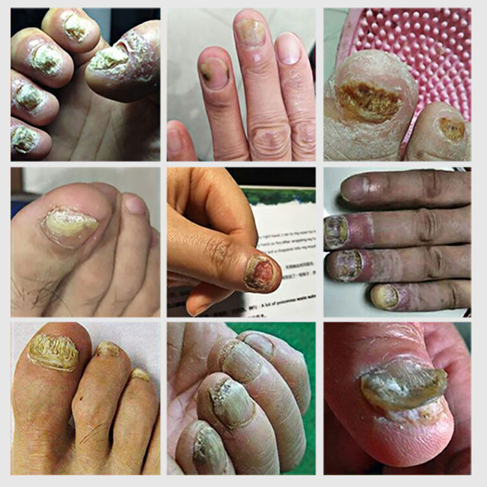 Nail Fungal Treatment Essence Oil Foot Toe Nail Fungus Removal Serum 7 Days Repair Onychomycosi Anti Infection Gel Care Nail Fungal Treatment Essence Oil Foot Toe Nail Fungus Removal Serum 7 Days Repair Onychomycosi Anti Infection Gel Care
